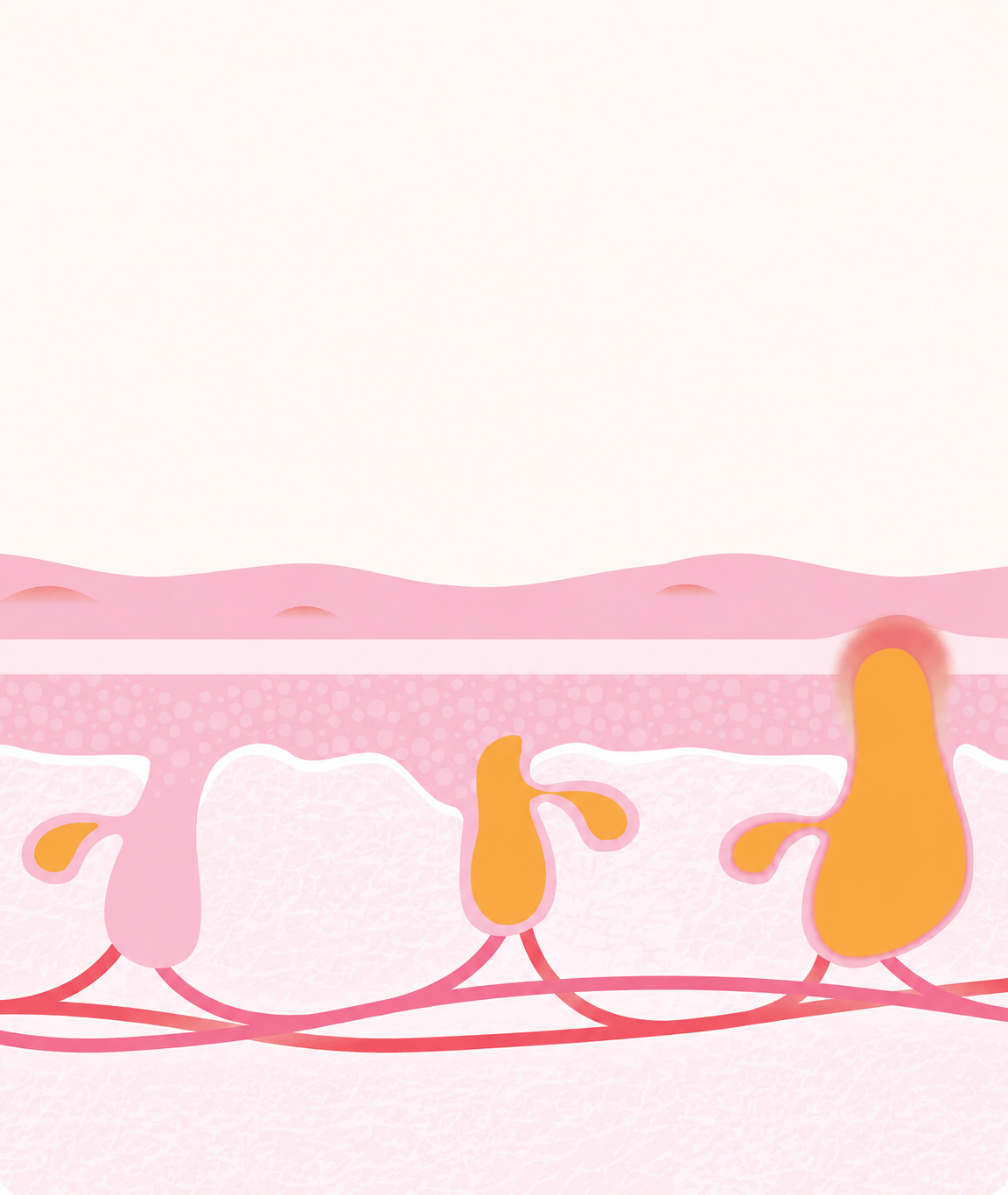Acné hormonal