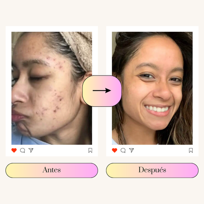 PMS RELIEF | BYE ACNÉ EN 3 MESES