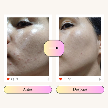 PMS RELIEF | BYE ACNÉ EN 3 MESES