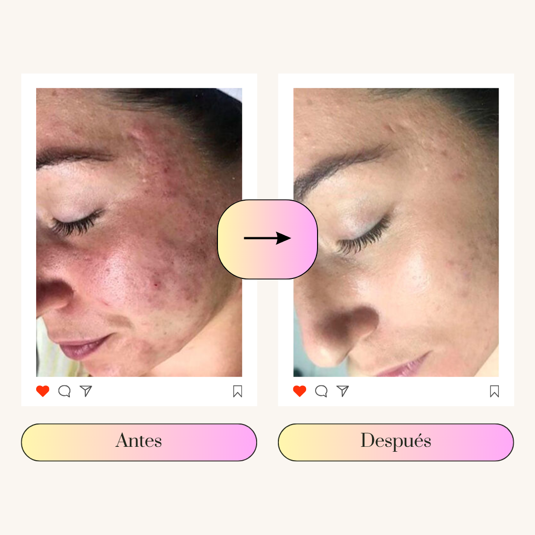 PMS RELIEF | BYE ACNÉ EN 3 MESES